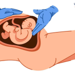 طريقة النوم الصحيحة بعد الولادة القيصرية