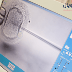 نسب تحليل الحمل الرقمي بعد الحقن المجهري